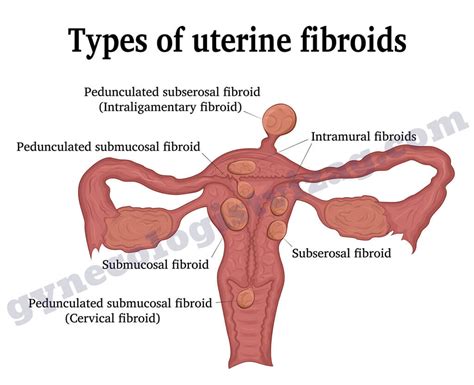 Uterine Fibroids Treatment In Visakhapatnam Fibroid Surgery