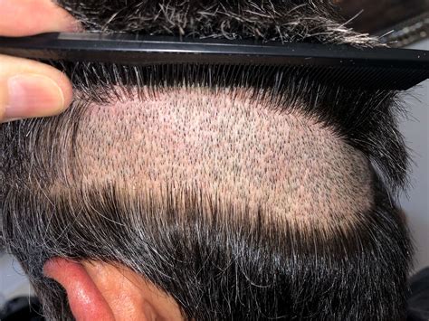 Fue Follicular Unit Extraction Hair Transplant Corrections Dr Brett Bolton