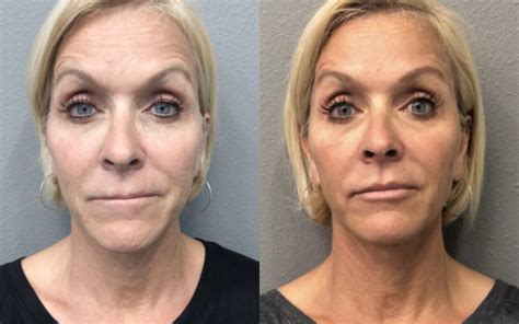 Botox® Before And After Gallery Radiance Medspa