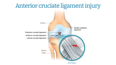 Anterior Cruciate Ligament Tear