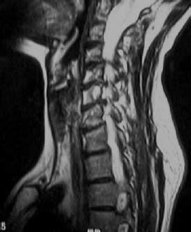 Cervical Spinal Stenosis Mri