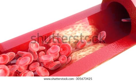 67 Arterial Calcification Images, Stock Photos & Vectors | Shutterstock