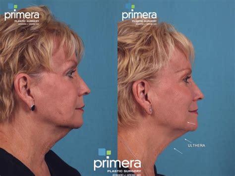 Ultherapy Before And After Pictures Case 387 Orlando Tampa