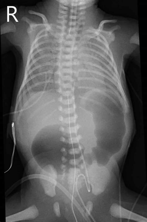 Duodenal atresia causes, symptoms, diagnosis, treatment & prognosis