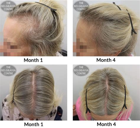 Female Pattern Hair Loss Pictures Photos