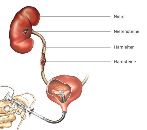 Harnleiterschiene Blut Im Urin Pregnant Health Tips