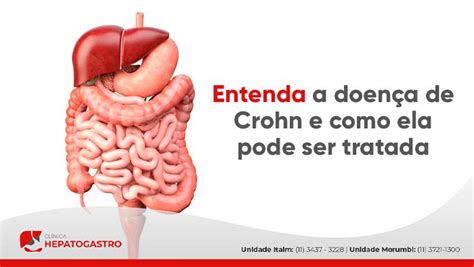 Doença de Crohn Felipe Gastro