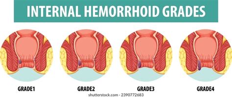 Hemorrhoid Grades Photos And Images Shutterstock