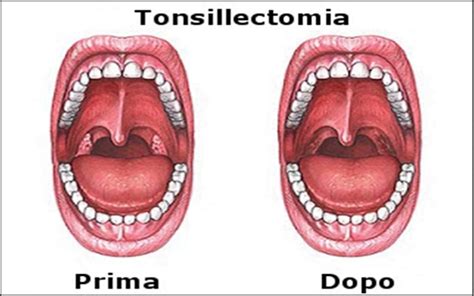 Tonsille A Cosa Servono Infezioni E Quando Rimuoverle