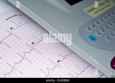 Ekg O Ecg Electrocardiograma Informe Gr Fico De Papel Prueba De