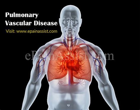 Enfermedad Vascular Pulmonar S Ntomas Causas Pruebas Y Tratamientos