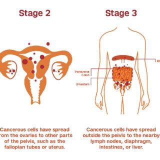 Ovarian Cancer Stages (Weill Cornell Medicine) | Download Scientific ...