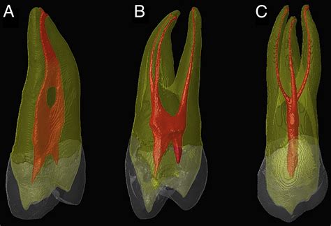 Endodontic Anatomy Of The Maxillary First Premolar Root Canal Anatomy