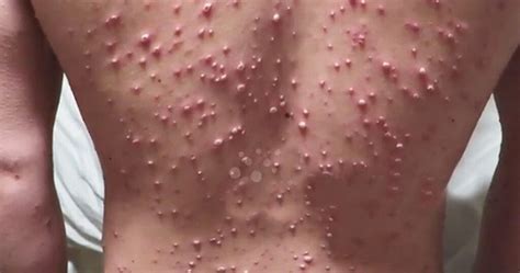 Varicella Negli Adulti Quali Sono I Sintomi