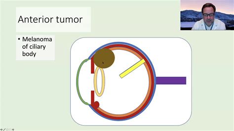 Side Effects of Brachytherapy (US) - YouTube