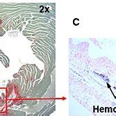 Iron deposition in hemosiderin in damaged tissues causes a signal void ...