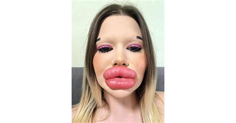 Woman With Worlds Biggest Lips Wants Huge Cheekbones Too Pet Is To Love