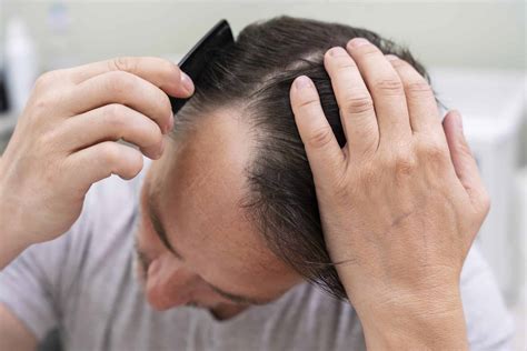 How To Regrow Hair On Bald Spot The Hair Dr