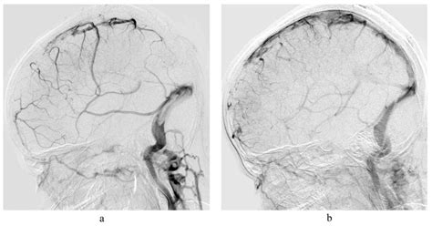 Jcm Free Full Text Mechanical Thrombectomy In Cerebral Venous Sinus