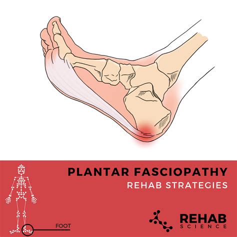 Plantar Fasciopathy Rehab Science