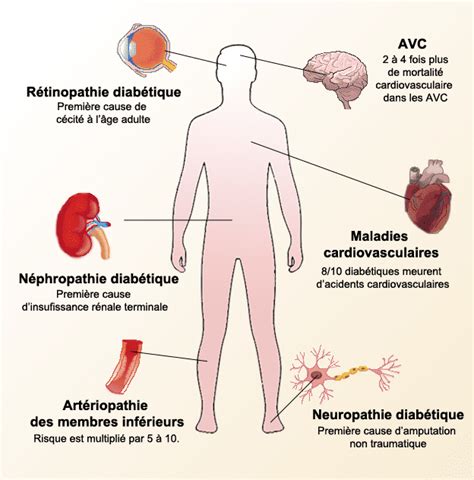 Comprendre Le Diabète Diabète 66