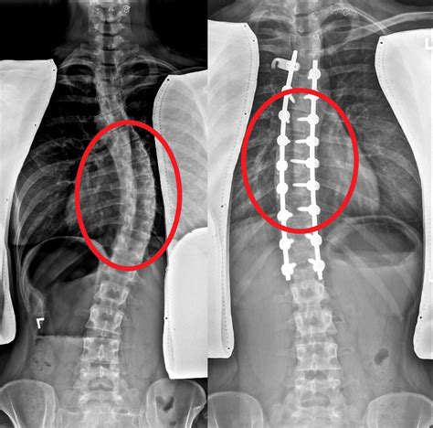 Spinal Deformities