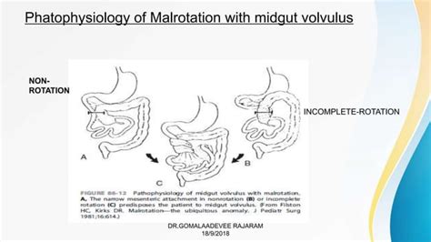 Malrotation With Midgut Volvuluspptx