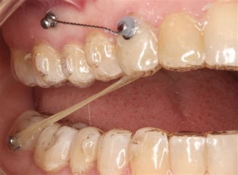 Los Microtornillos En Ortodoncia Artis Dental