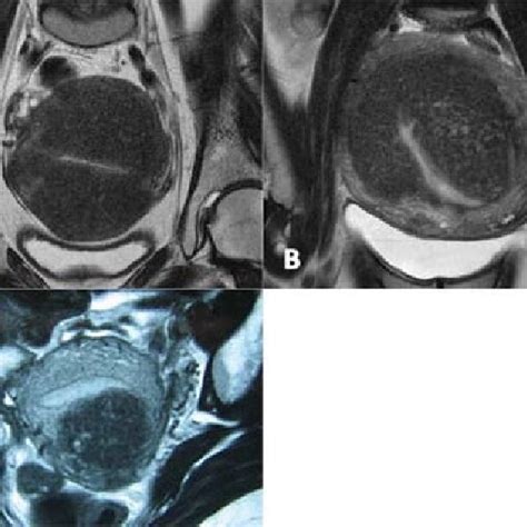 T Weighted Mr Imaging A B Oblique View Of Diffuse Type Adenomyosis