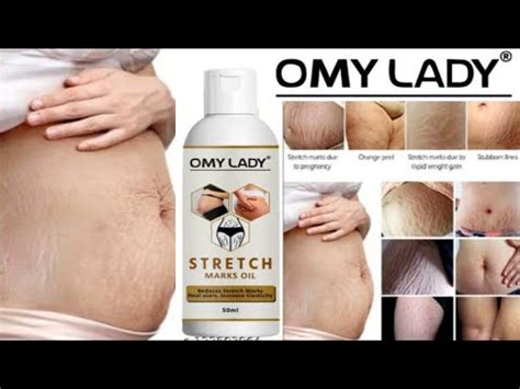 Which Is The Best Stretch Mark Removal Oil Omy Lady Stretch Marks Oil