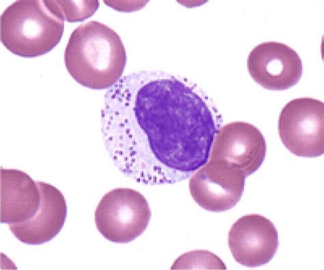 Grandes Linfócitos Granulares - Hemoclass - Hematologia e Medicina Diagnóstica