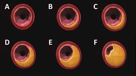 ARTERIOSCLEROSIS Y GERMENES Enriquerubio Net