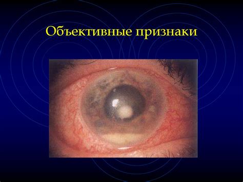 Язвы роговицы - online presentation