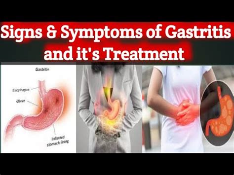 Signs Systems Of Gastritis And It S Treatment In Urdu Hindi Thhari