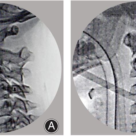 Pre‐ And Post‐reduction Intraoperative X‐ray Download Scientific Diagram