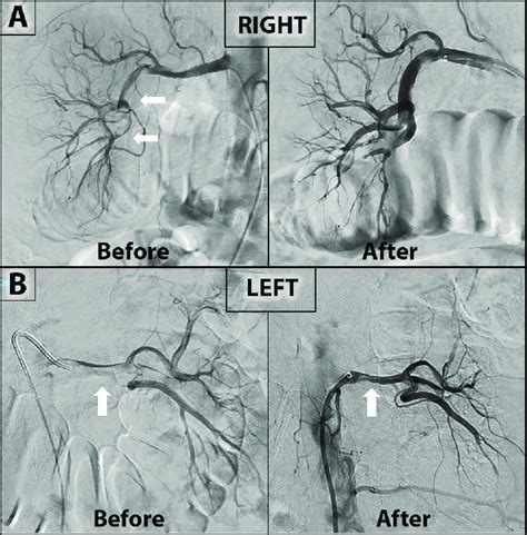 Selective Catheter Angiogram Of Renal Arteries A The Right Renal Download Scientific Diagram