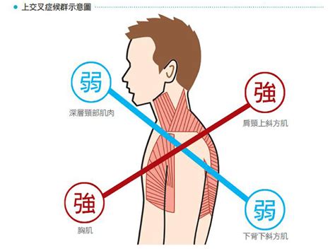 上班族注意！常感覺肩膀不舒服？小心得了電腦肩