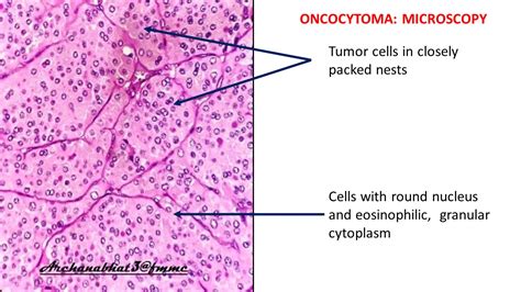 Pathology of Renal Oncocytoma | Pathology Made Simple