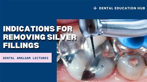 Indications for Removing Silver Fillings | Dental Amalgam Fillings - Dental Clinic