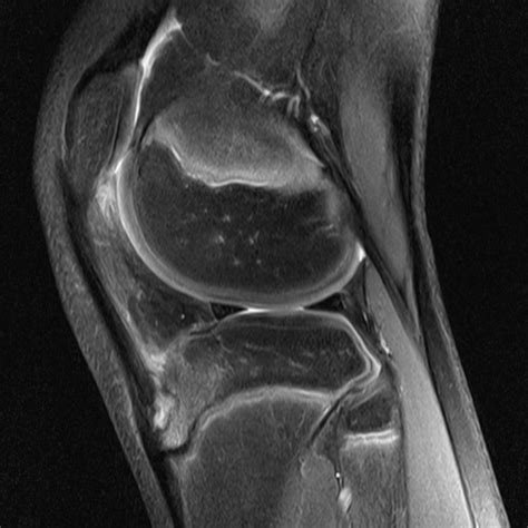 Radiology Cases: Osgood Schlatter Disease