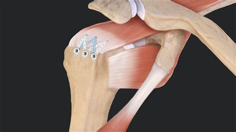 What Is The Satisfaction After Repair Of Arthroscopic Repair Of Massive