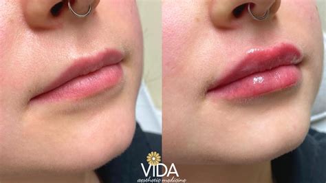 Injectables Photos VIDA Aesthetic Medicine Salem Oregon