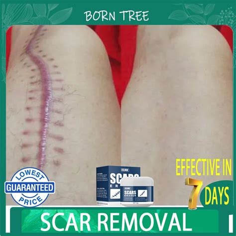 Scar Gel By Doc Willie Ong Scars Remover For Old Scars Fix Scar Removal