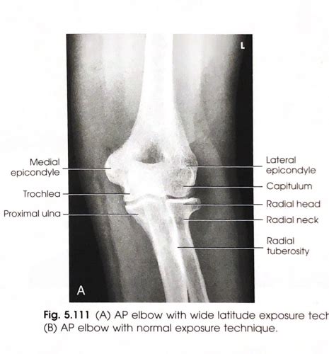 Positioning Elbow Pt Flashcards Quizlet