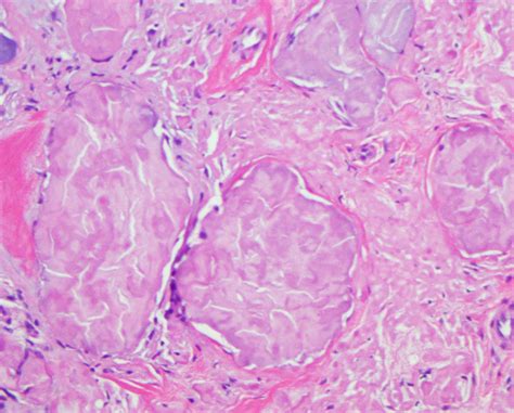 Nodular Amyloidosis Associated With Scleroderma Dermatopathology