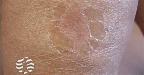 Pityriasis Lichenoides Image