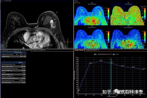 磁共振增强扫描的临床应用 知乎