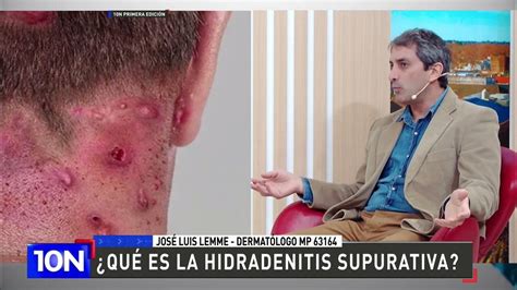 ¿qué Es La Hidradenitis Supurativa Youtube