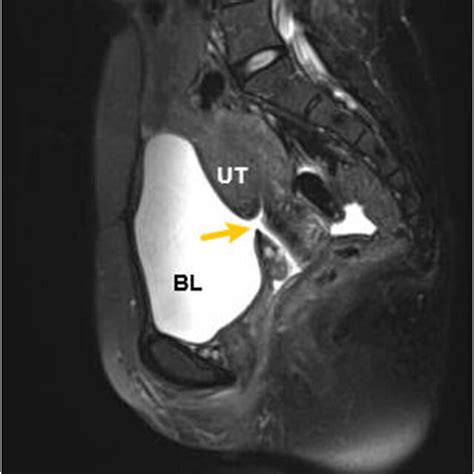 Mri A Fissure In The Posterior Wall Of The Bladder And The Uterine