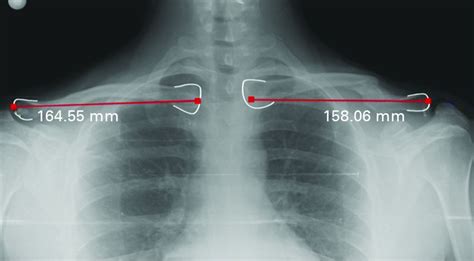 Comparison Of Simple Arm Sling And Figure Of Eight Clavicular Bandage